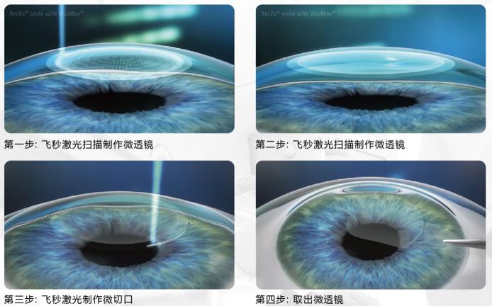全飞秒激光手术
