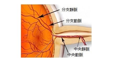 视网膜中央静脉阻塞的症状