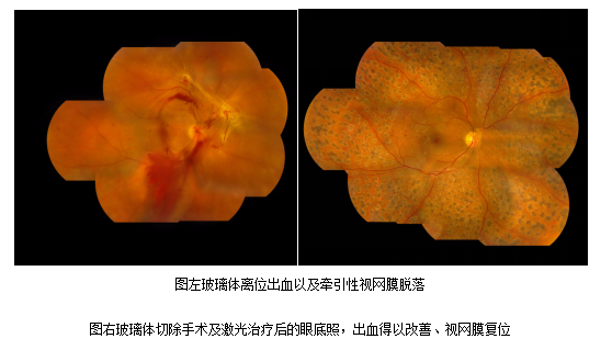 视网膜脱落的症状