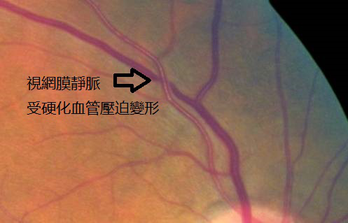 视网膜动脉阻塞治疗有效时间,眼中风怎么治