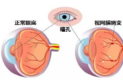 昆明眼科医院，全家眼健康检查，视网膜病变/脱落，高度近视