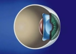 昆明眼科，全飞秒手术，半飞秒手术，ICL，2023昆明近视手术价格表