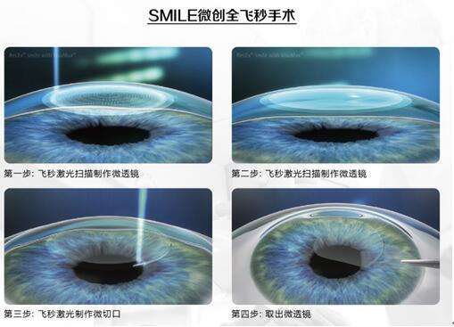 昆明眼科医院，参军近视手术，全飞秒手术，2023年参军近视手术价格一览表