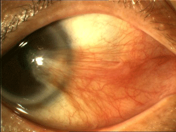 眼底黄斑病变能治好吗,紫外线易患白内障风险