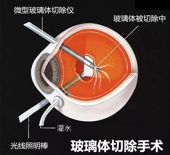 高度近视并发症