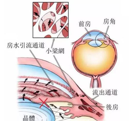 青光眼白内障联合术