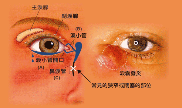 泪道阻塞是什么