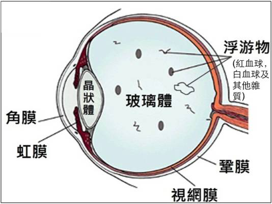 视网膜裂孔
