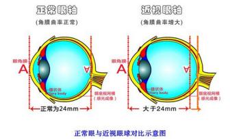 眼轴,眼镜质量,视网膜,角膜塑形镜,近视多焦点眼