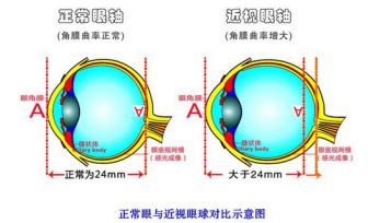 近视矫正办法