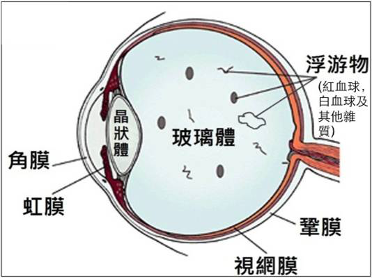 眼前老有黑影飞来飞去是怎么回事