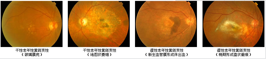 眼睛黄斑是什么？有什么危害