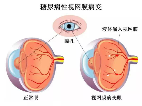 糖尿病的眼病有哪些