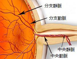 眼中风是什么