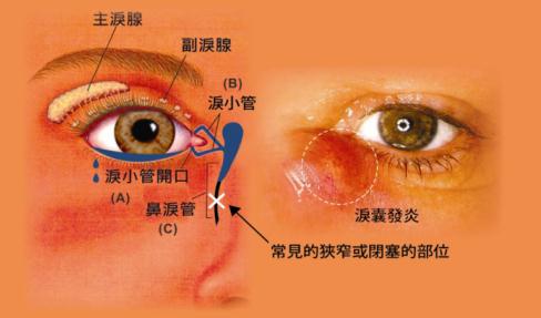 干眼症怎么治疗好