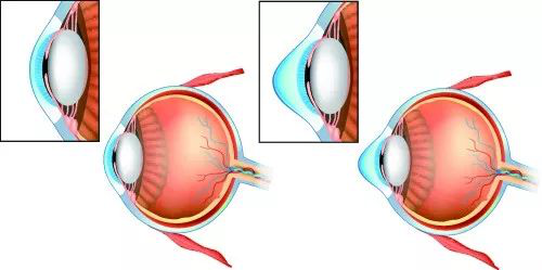 圆锥角膜是什么眼病？
