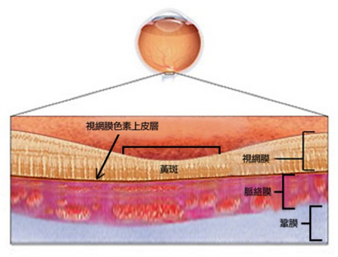 眼中浆严重吗？可以治好吗