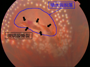 昆明哪家眼科医院治视网膜脱落好？