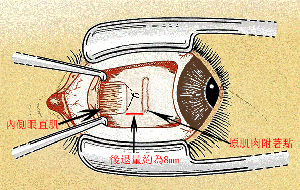 孩子做斜视手术风险大吗？