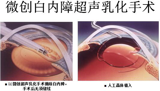 昆明白内障手术多少钱！