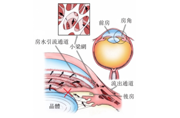 昆明青光眼和白内障能够一起治疗吗