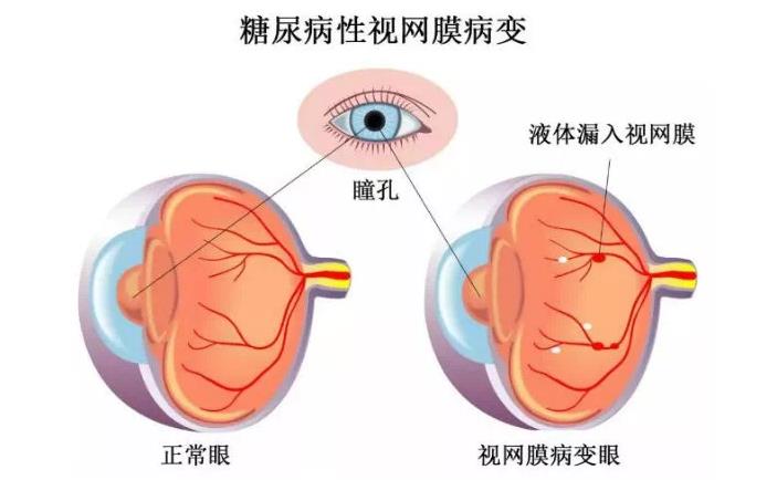 糖尿病视网膜病变怎么治疗好得快？