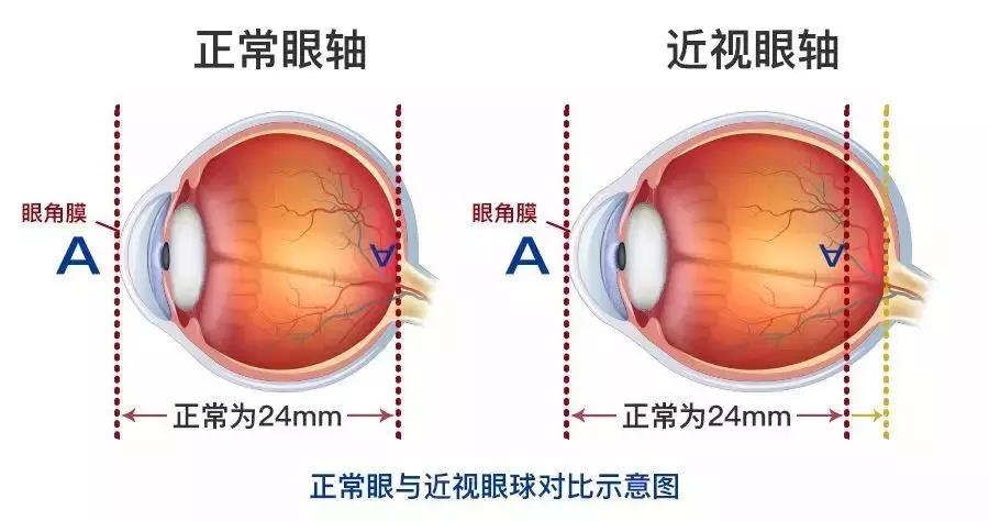 高度近视能做激光近视手术吗？