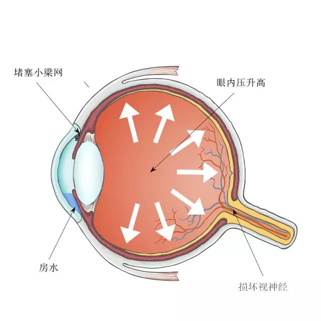 青光眼可以治好吗？