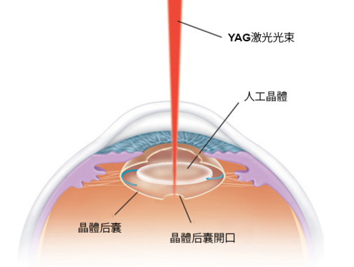 白内障风险大吗？会复发吗？