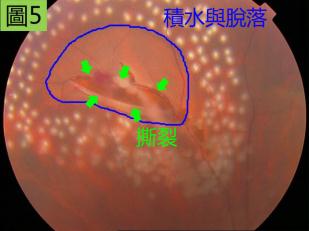 外伤引起的视网膜裂孔严重么？