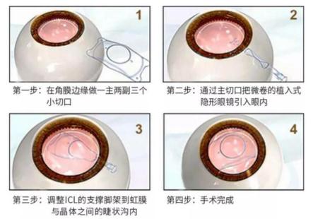 云南做icl手术价格表