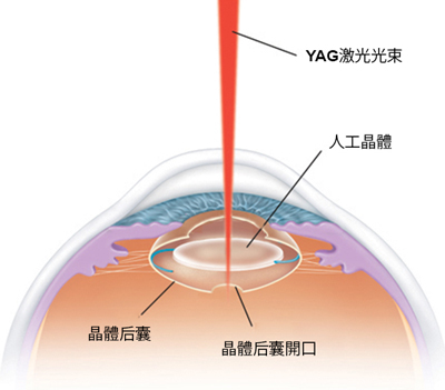 飞蚊症严重吗？不治疗会怎么样