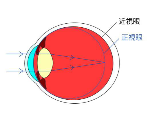 近视眼手术