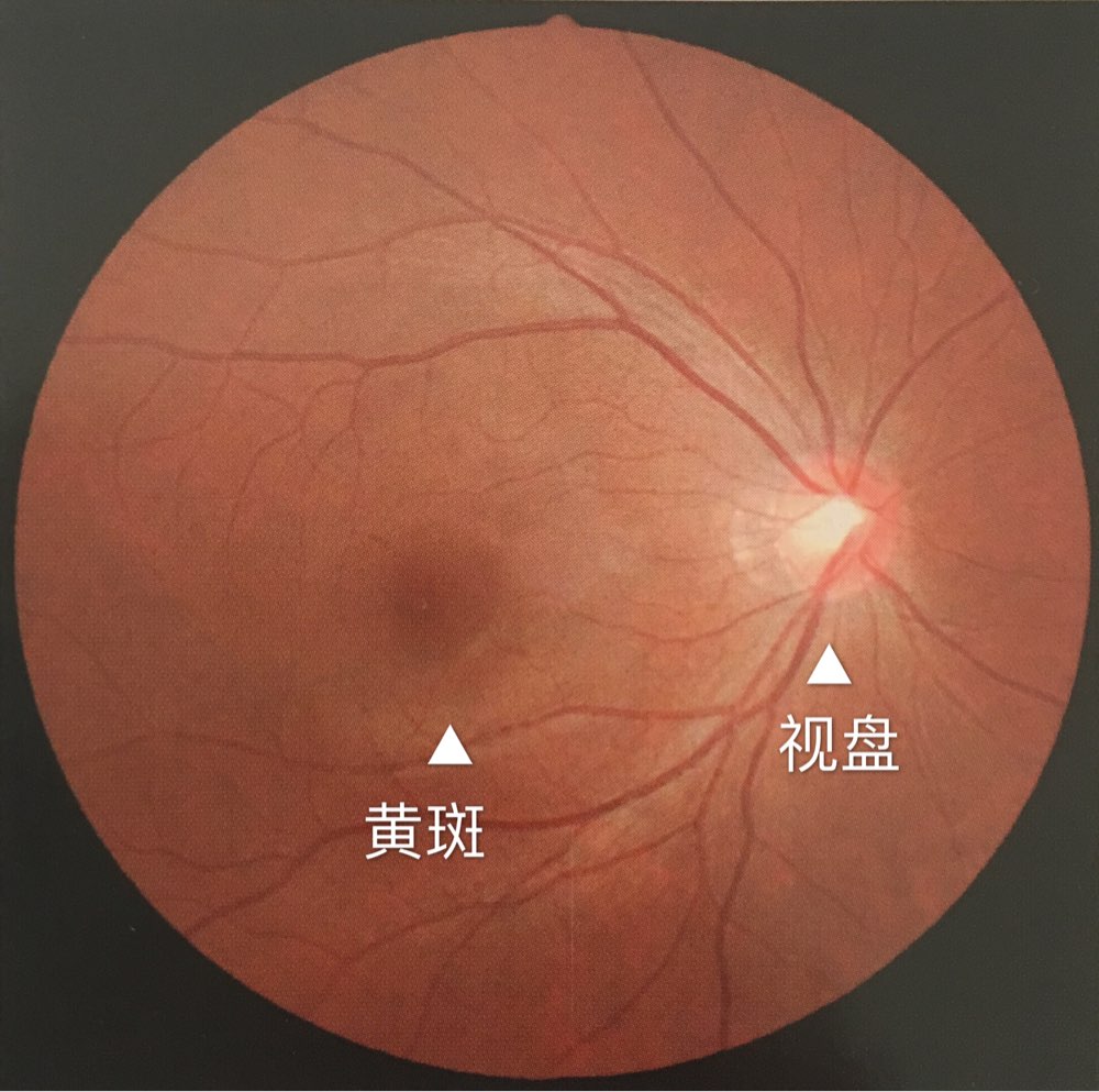 高度近视患者易导致视网膜脱落