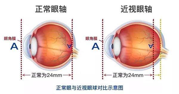 近视眼与正常人的眼睛对比图