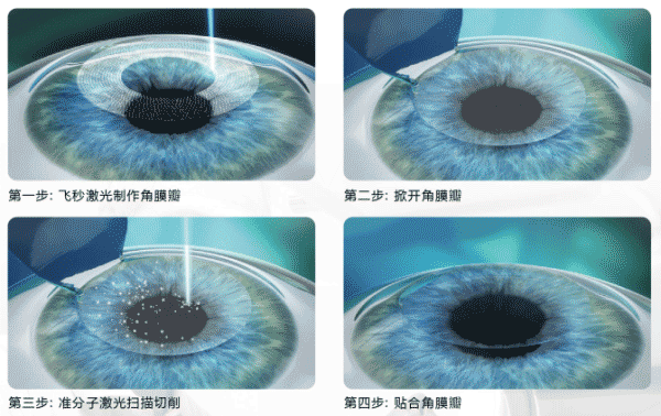 半飞秒激光手术