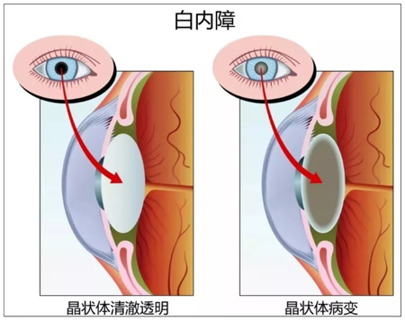 昆明白内障成因