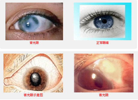 青光眼5大症状图片
