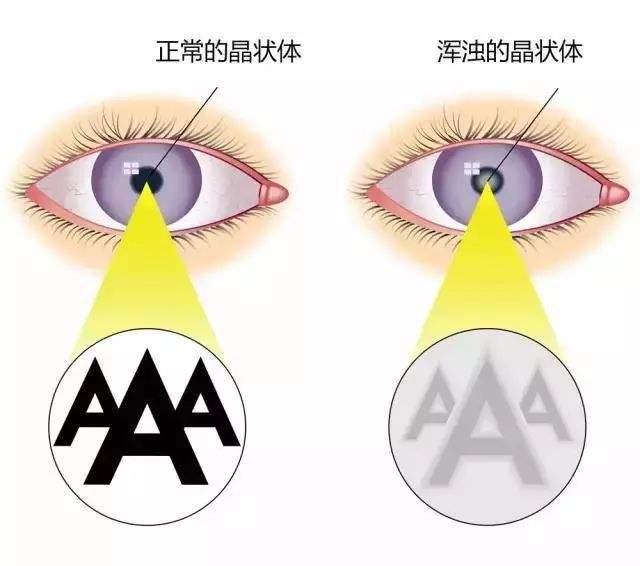 白内障手术之后"复发"了怎么办?